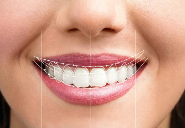 What Is a Smile Makeover and How It Can Effectively Transform Your Life?