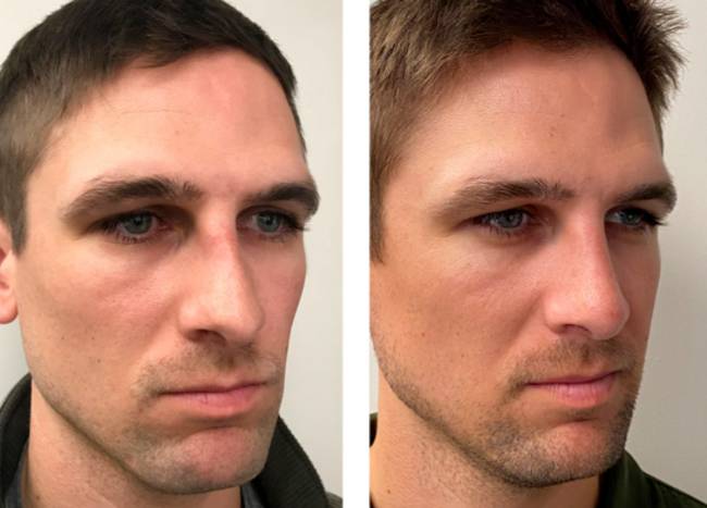 How to get a rhinoplasty covered by insurance?