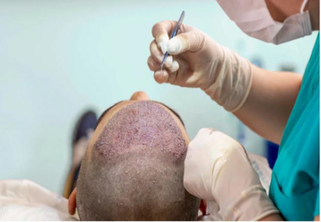 The Inside Scoop on Hair Transplant Prices in Turkey
